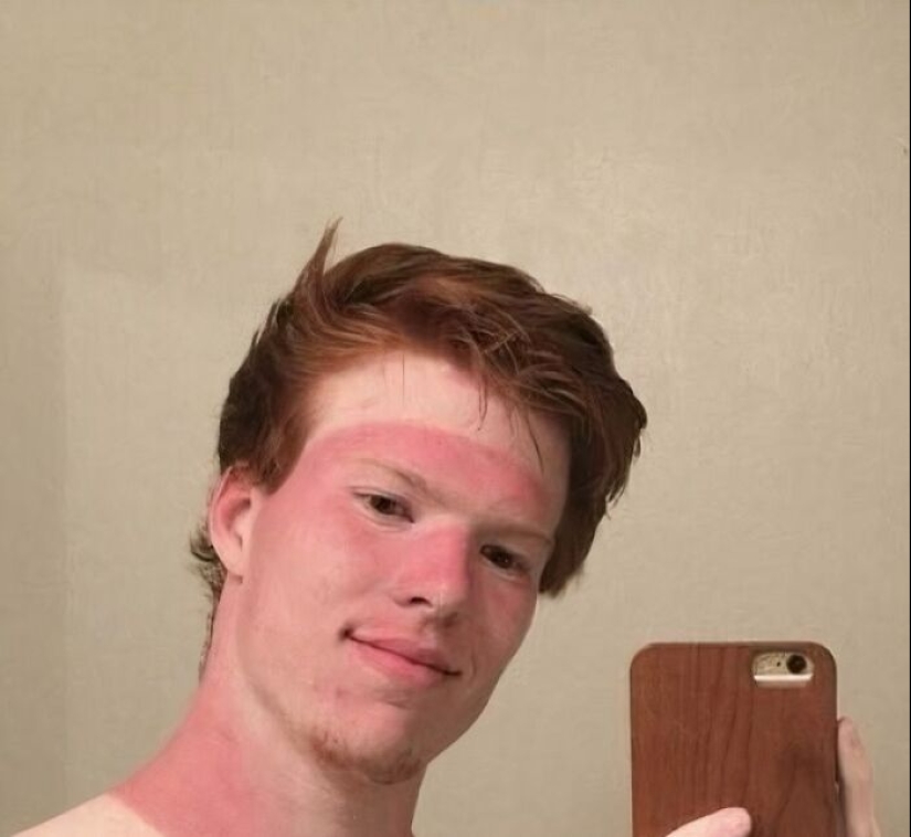 15 People Who Thought They Didn’t Need Sunscreen And Ended Up Looking Like Dorks 15 People Who Thought They Didn’t Need Sunscreen And Ended Up Looking Like Dorks