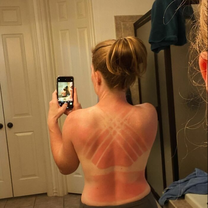 15 People Who Thought They Didn’t Need Sunscreen And Ended Up Looking Like Dorks 15 People Who Thought They Didn’t Need Sunscreen And Ended Up Looking Like Dorks