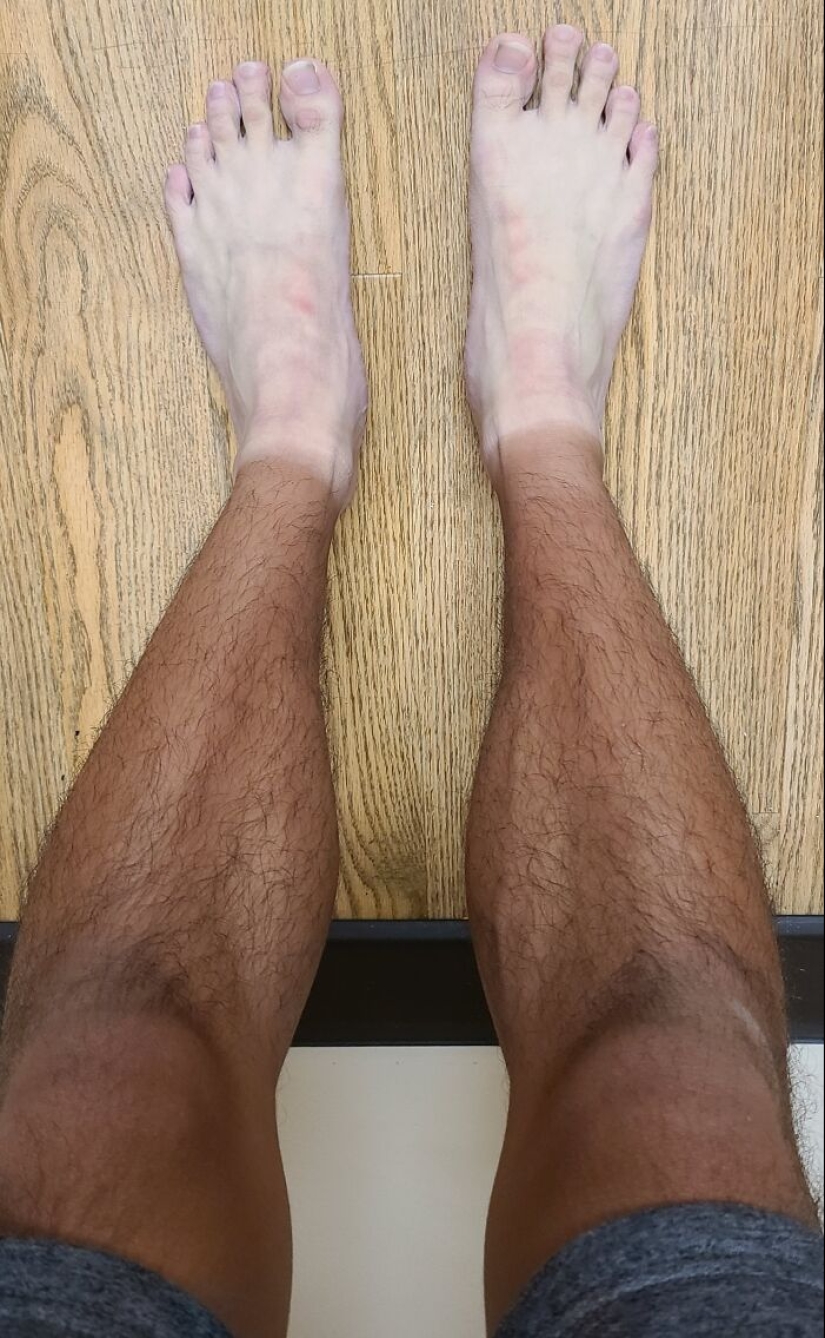 15 People Who Thought They Didn’t Need Sunscreen And Ended Up Looking Like Dorks 15 People Who Thought They Didn’t Need Sunscreen And Ended Up Looking Like Dorks