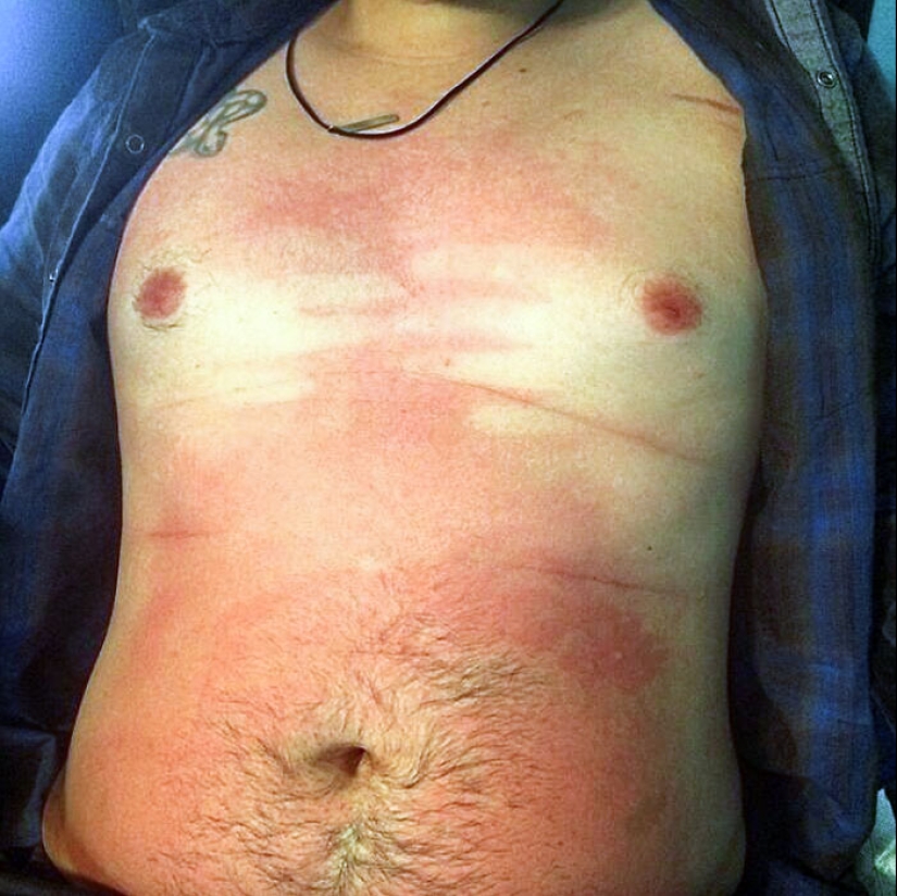 15 People Who Thought They Didn’t Need Sunscreen And Ended Up Looking Like Dorks 15 People Who Thought They Didn’t Need Sunscreen And Ended Up Looking Like Dorks