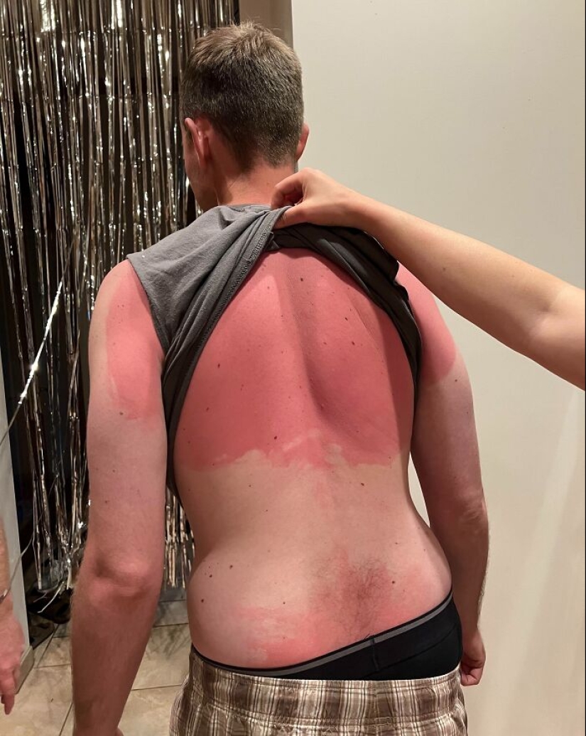 15 People Who Thought They Didn’t Need Sunscreen And Ended Up Looking Like Dorks 15 People Who Thought They Didn’t Need Sunscreen And Ended Up Looking Like Dorks