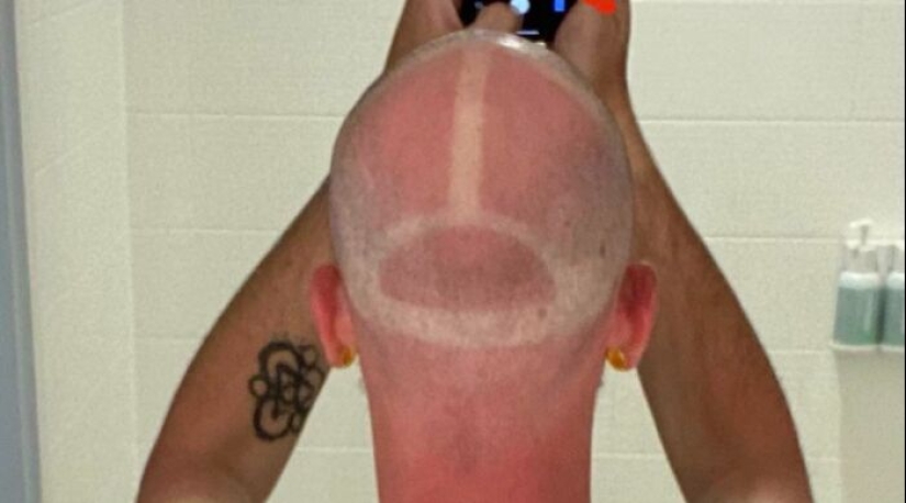 15 People Who Thought They Didn’t Need Sunscreen And Ended Up Looking Like Dorks 15 People Who Thought They Didn’t Need Sunscreen And Ended Up Looking Like Dorks