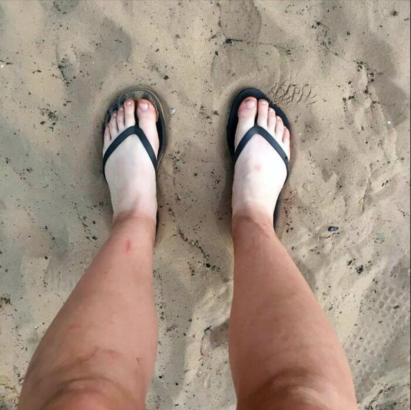 15 People Who Thought They Didn’t Need Sunscreen And Ended Up Looking Like Dorks 15 People Who Thought They Didn’t Need Sunscreen And Ended Up Looking Like Dorks