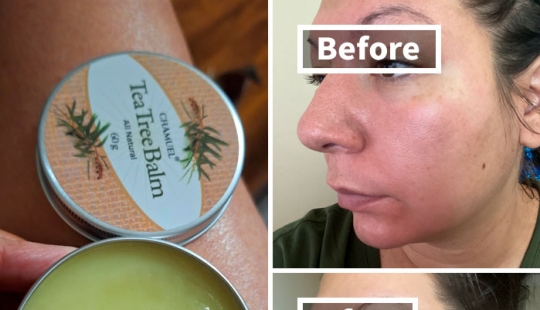19 Beauty Solutions For Those Winter Issues Nobody Wants To Talk About 19 Beauty Solutions For Those Winter Issues Nobody Wants To Talk About