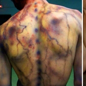 After discharge: what happens to a man who was struck by lightning After discharge: what happens to a man who was struck by lightning