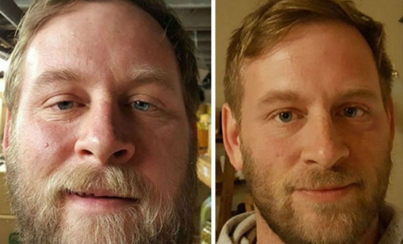 Before and after: how does the appearance of a person who stops drinking change Before and after: how does the appearance of a person who stops drinking change