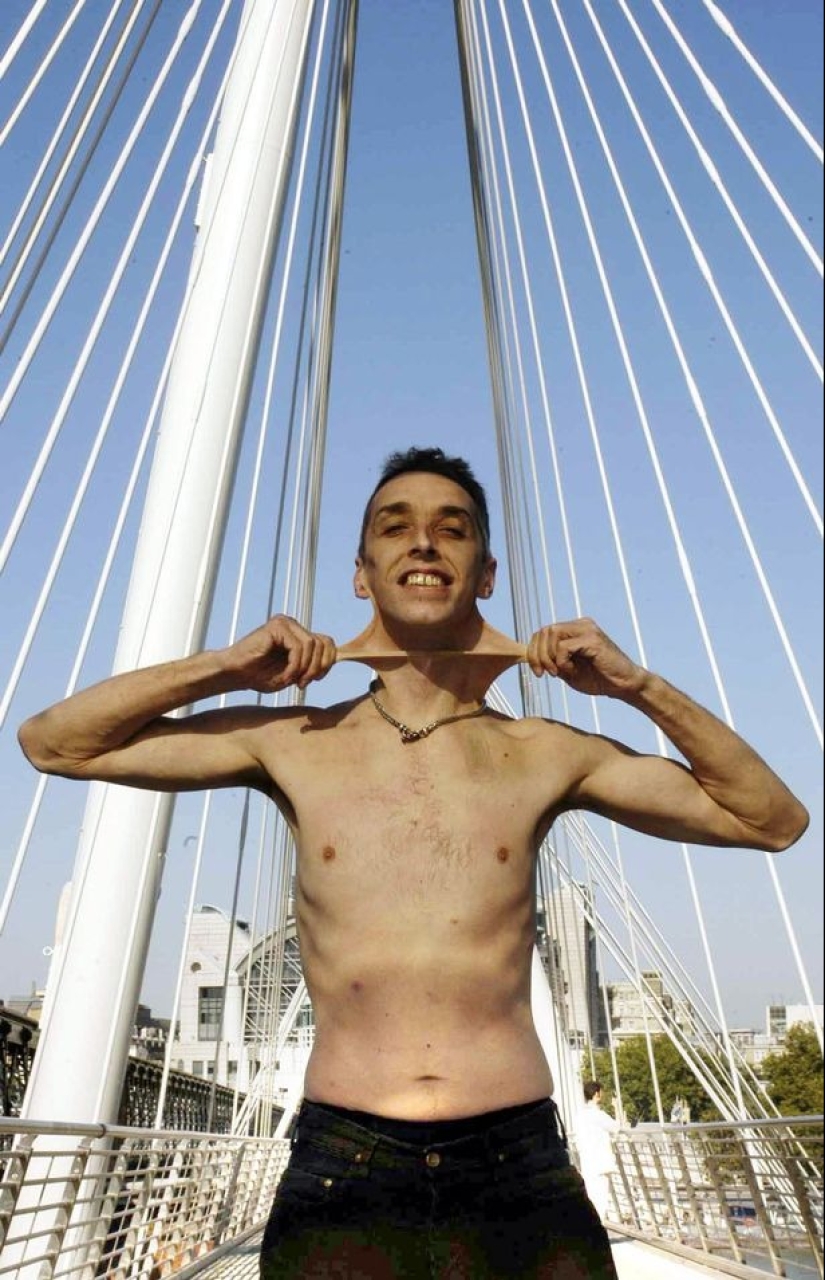Cara de goma: cómo vive Harry Turner, el hombre con la piel más elástica del mundo Cara de goma: cómo vive Harry Turner, el hombre con la piel más elástica del mundo