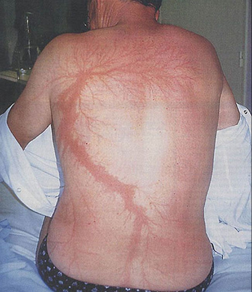 Después de la descarga: ¿qué le sucede a un hombre que fue alcanzado por un rayo Después de la descarga: ¿qué le sucede a un hombre que fue alcanzado por un rayo