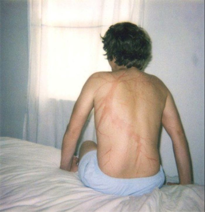 Después de la descarga: ¿qué le sucede a un hombre que fue alcanzado por un rayo Después de la descarga: ¿qué le sucede a un hombre que fue alcanzado por un rayo