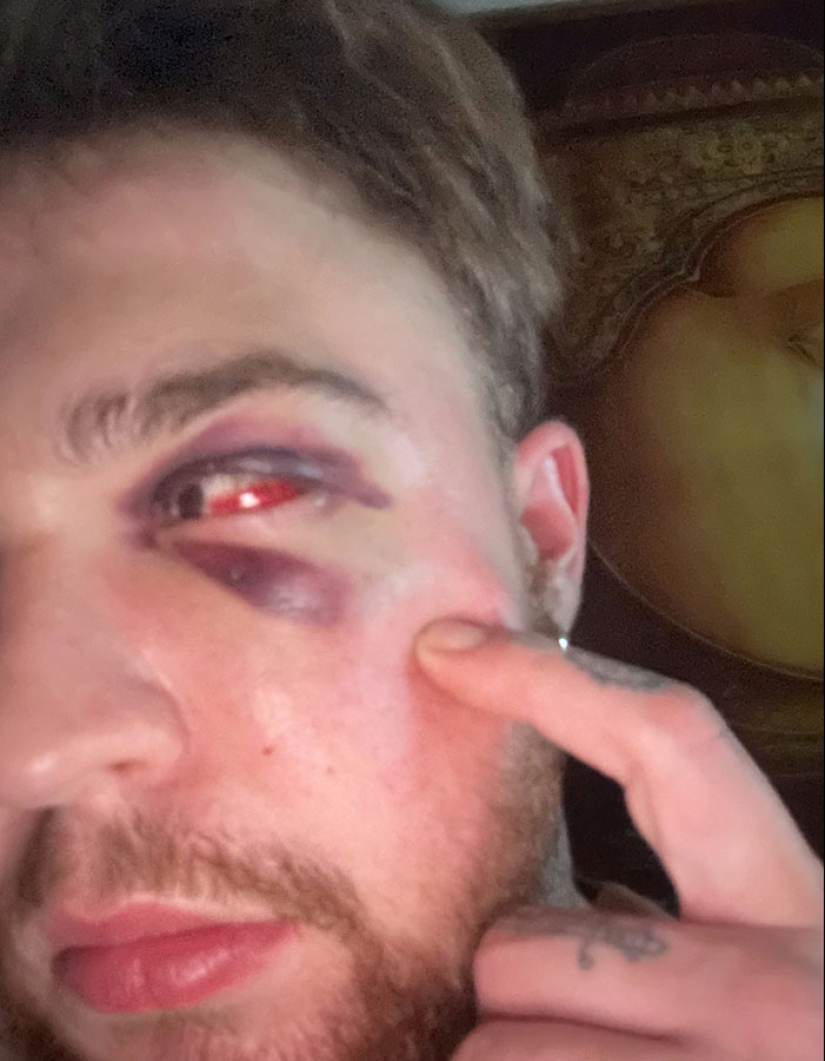 Hombre trans de 29 años es brutalmente golpeado en Suiza y afirma que es un crimen de odio Hombre trans de 29 años es brutalmente golpeado en Suiza y afirma que es un crimen de odio