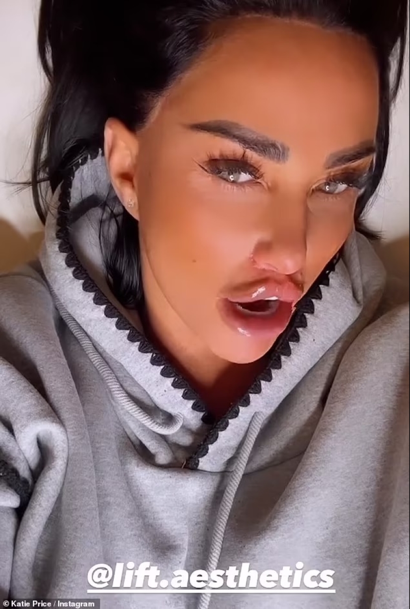 Katie Price sorprende al revelar los resultados de su 'levantamiento de trasero' en una PEQUEÑA tanga negra