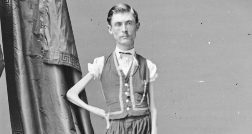 La trágica historia del "esqueleto viviente" Isaac Sprague La trágica historia del "esqueleto viviente" Isaac Sprague