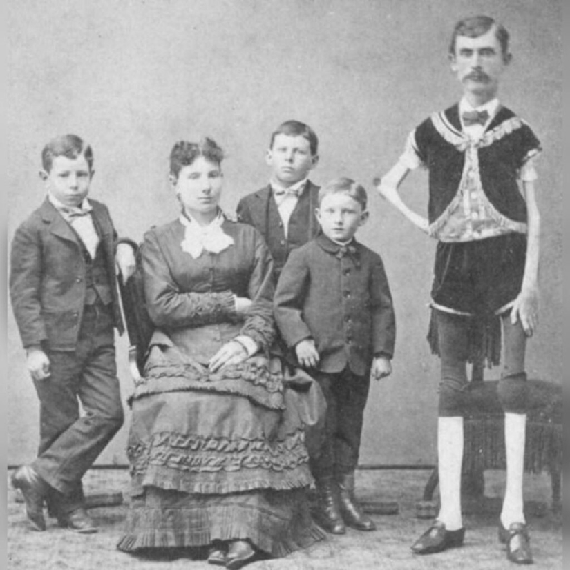 La trágica historia del "esqueleto viviente" Isaac Sprague La trágica historia del "esqueleto viviente" Isaac Sprague