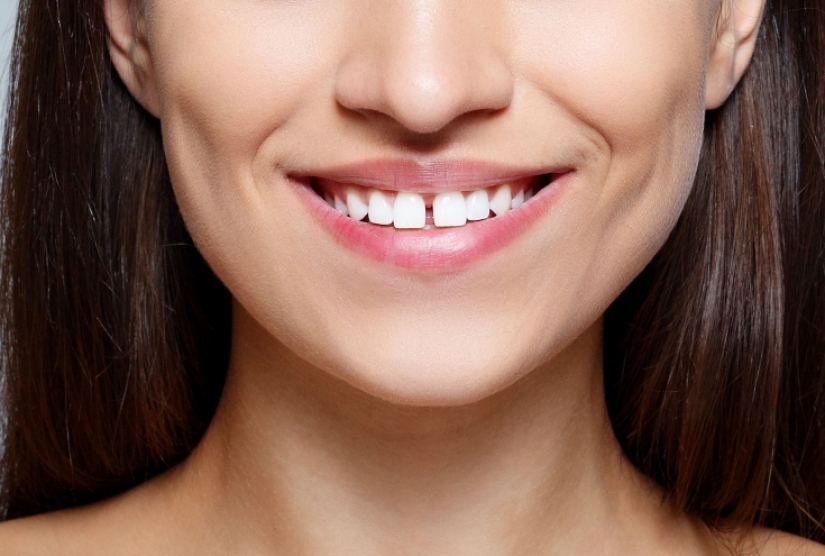 Monobrow, braces and 8 more appearance flaws that are considered attractive by other peoples Monobrow, braces and 8 more appearance flaws that are considered attractive by other peoples