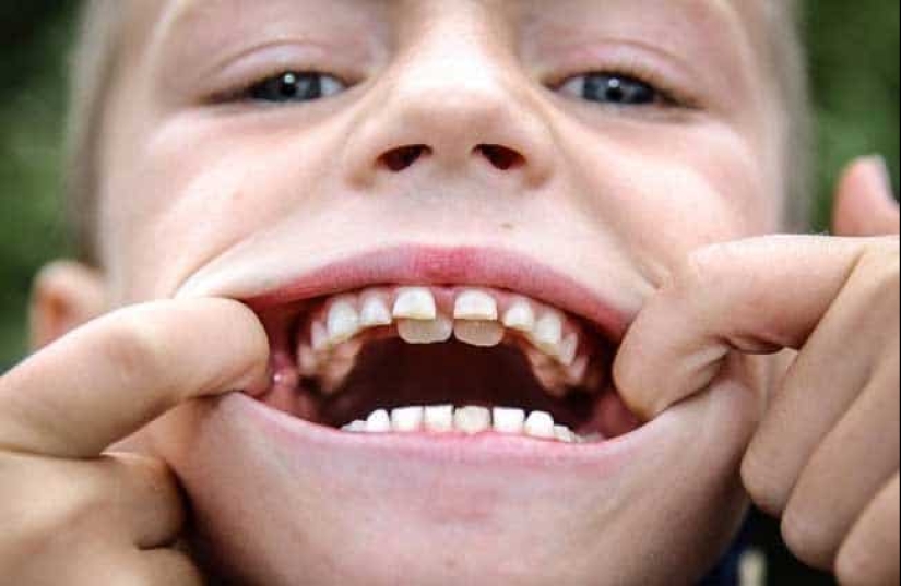 ¿Por qué sueñas con perder dientes y vale la pena tener miedo de tal sueño