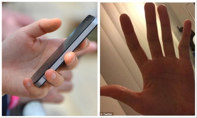 Smart Pinky: los usuarios de teléfonos inteligentes están experimentando cada vez más deformidad en los dedos Smart Pinky: los usuarios de teléfonos inteligentes están experimentando cada vez más deformidad en los dedos