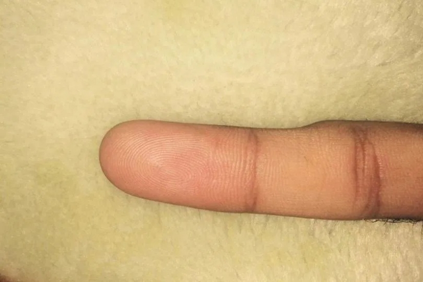 Smart Pinky: los usuarios de teléfonos inteligentes están experimentando cada vez más deformidad en los dedos Smart Pinky: los usuarios de teléfonos inteligentes están experimentando cada vez más deformidad en los dedos