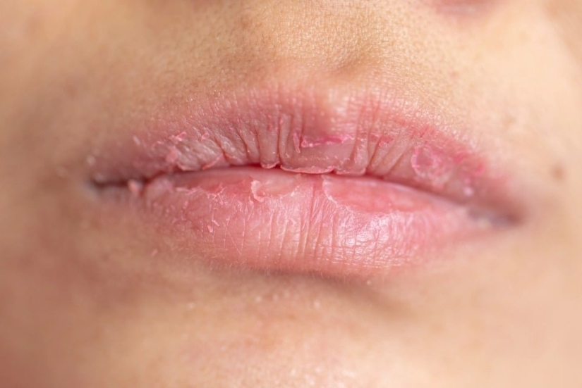 Winter, cold, cracked lip: 8 tips for skin care in the cold season Winter, cold, cracked lip: 8 tips for skin care in the cold season
