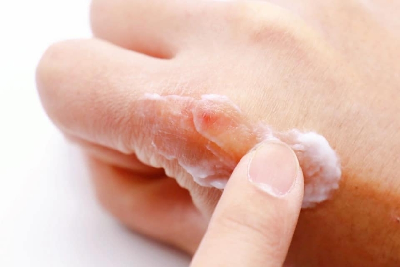 Winter, cold, cracked lip: 8 tips for skin care in the cold season Winter, cold, cracked lip: 8 tips for skin care in the cold season