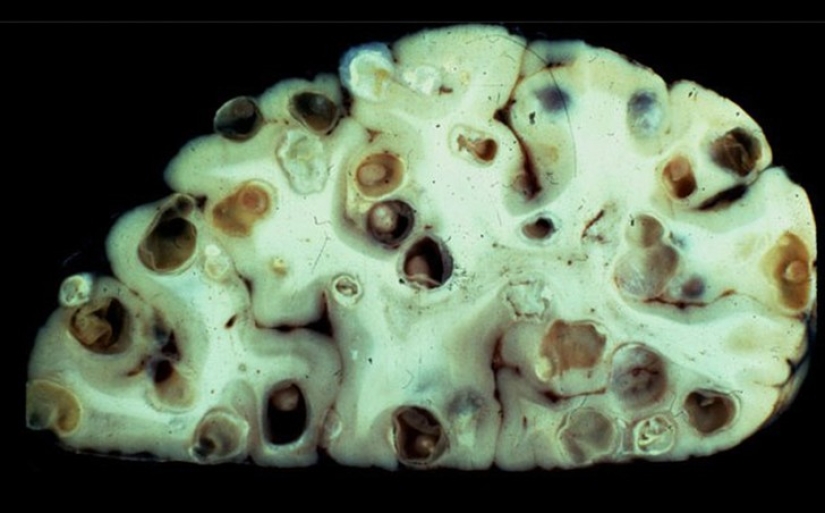 10 de los parásitos más peligrosos que pueden vivir en el cuerpo humano 10 de los parásitos más peligrosos que pueden vivir en el cuerpo humano