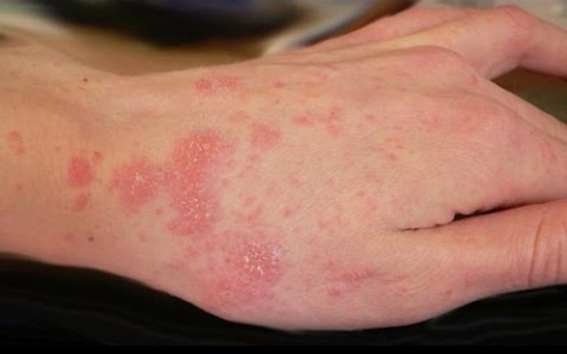 10 de los parásitos más peligrosos que pueden vivir en el cuerpo humano 10 de los parásitos más peligrosos que pueden vivir en el cuerpo humano