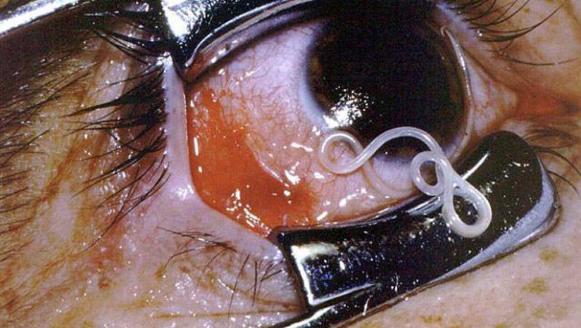 25 Most Unusual and Dangerous Parasites 25 Most Unusual and Dangerous Parasites