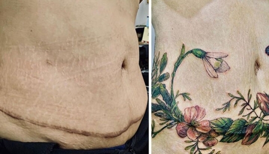 25 tatuajes para cubrir cicatrices y otros defectos en el cuerpo