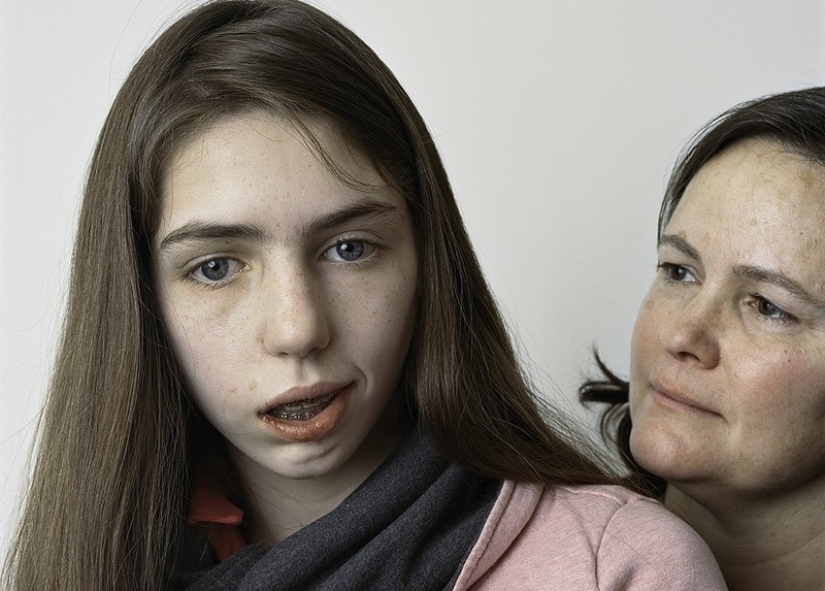 About Face: photo portraits of people suffering from paralysis About Face: photo portraits of people suffering from paralysis