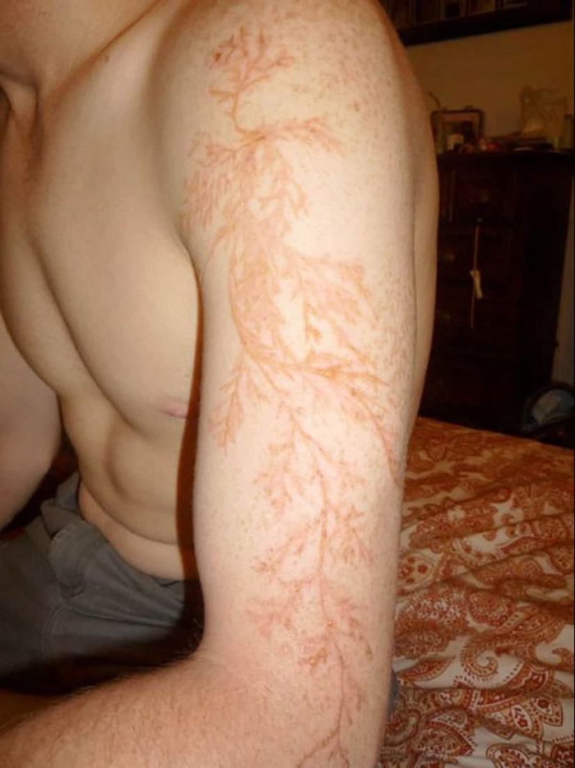 After discharge: what happens to a man who was struck by lightning