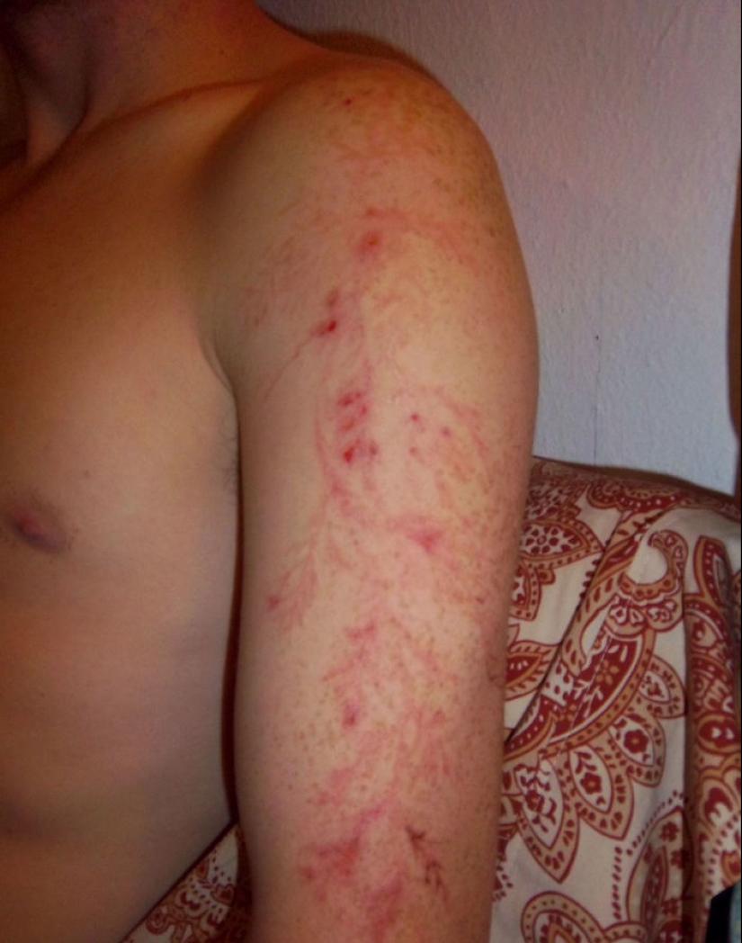 After discharge: what happens to a man who was struck by lightning