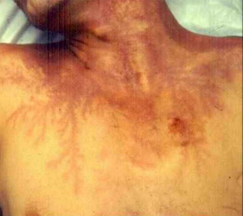 After discharge: what happens to a man who was struck by lightning