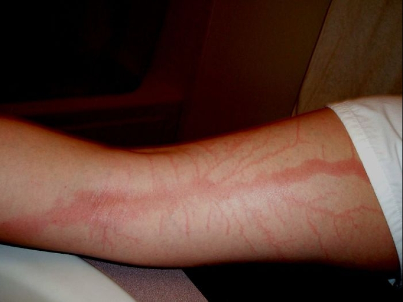 After discharge: what happens to a man who was struck by lightning