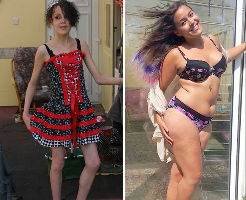Antes y después: 20 ejemplos de personas que lograron superar la anorexia