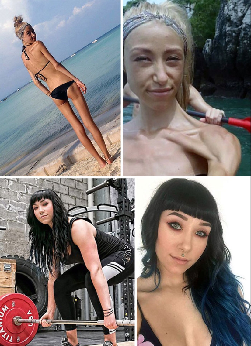 Antes y después: 20 ejemplos de personas que lograron superar la anorexia