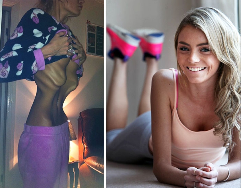 Antes y después: 20 ejemplos de personas que lograron superar la anorexia