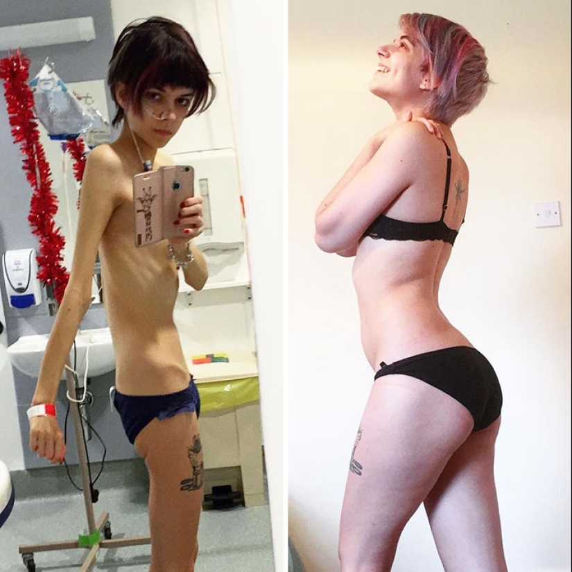 Antes y después: 20 ejemplos de personas que lograron superar la anorexia