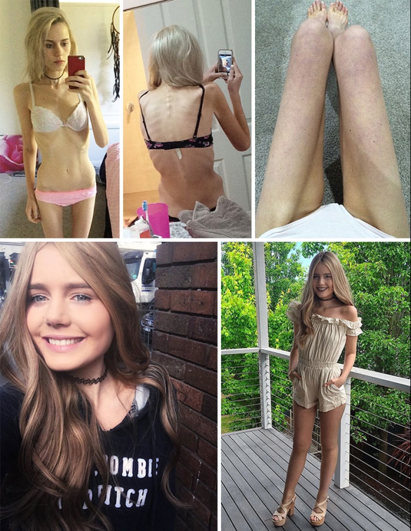 Antes y después: 20 ejemplos de personas que lograron superar la anorexia