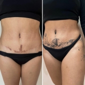 Artista del tatuaje cubre cicatrices con delicados diseños, y aquí están sus 10 mejores transformaciones Artista del tatuaje cubre cicatrices con delicados diseños, y aquí están sus 10 mejores transformaciones