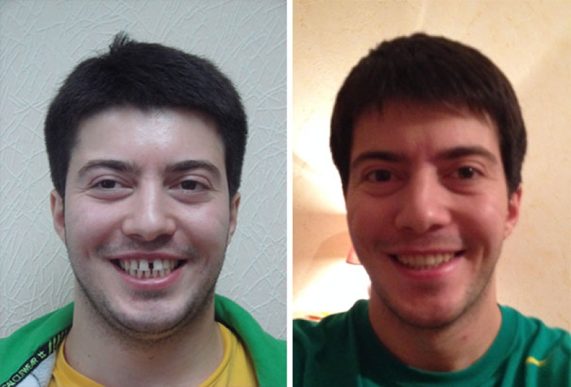 Así es como los aparatos de ortodoncia cambian radicalmente una sonrisa y la vida