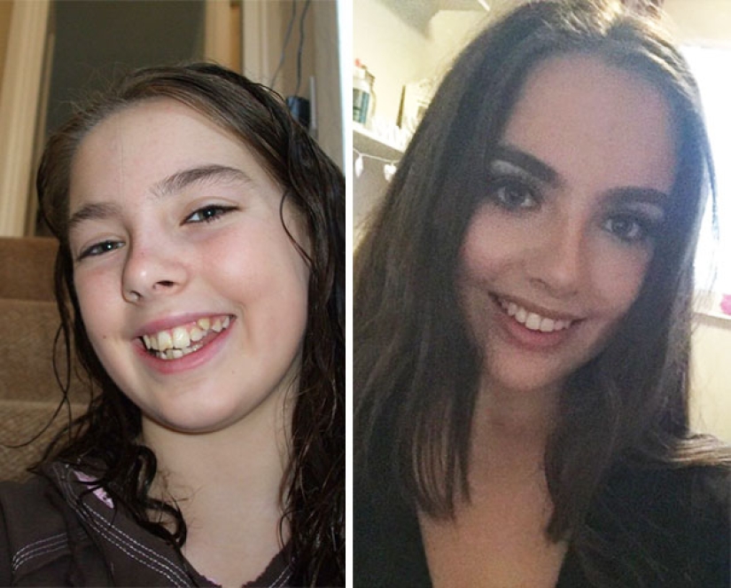 Así es como los aparatos de ortodoncia cambian radicalmente una sonrisa y la vida