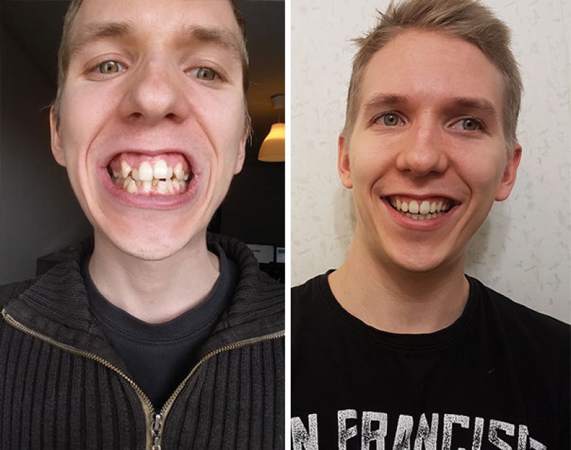 Así es como los aparatos de ortodoncia cambian radicalmente una sonrisa y la vida