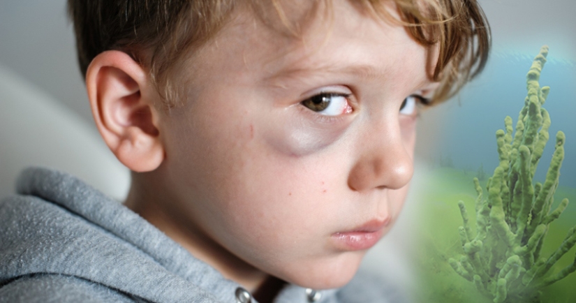 Badyaga: te salva de moretones, y ni siquiera sabes que no es una planta Badyaga: te salva de moretones, y ni siquiera sabes que no es una planta