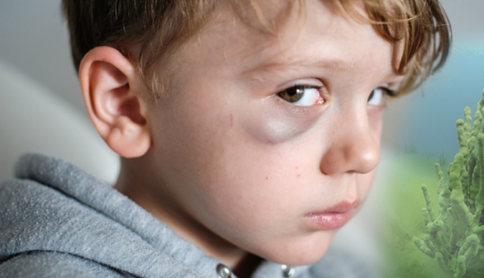 Badyaga: te salva de moretones, y ni siquiera sabes que no es una planta Badyaga: te salva de moretones, y ni siquiera sabes que no es una planta