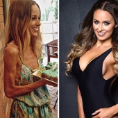 Before and after: 20 examples of people who managed to overcome anorexia Before and after: 20 examples of people who managed to overcome anorexia