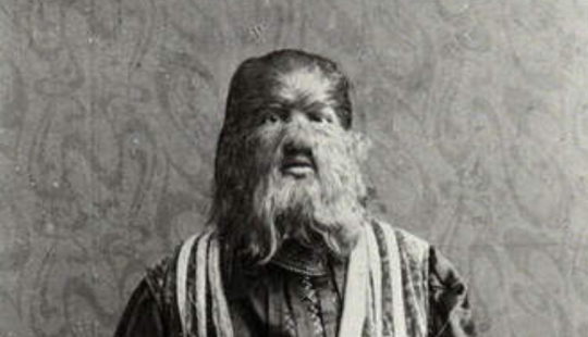 Cómo el “niño perro” ruso Fedya Evtikhiev se convirtió en una estrella de circo en Estados Unidos