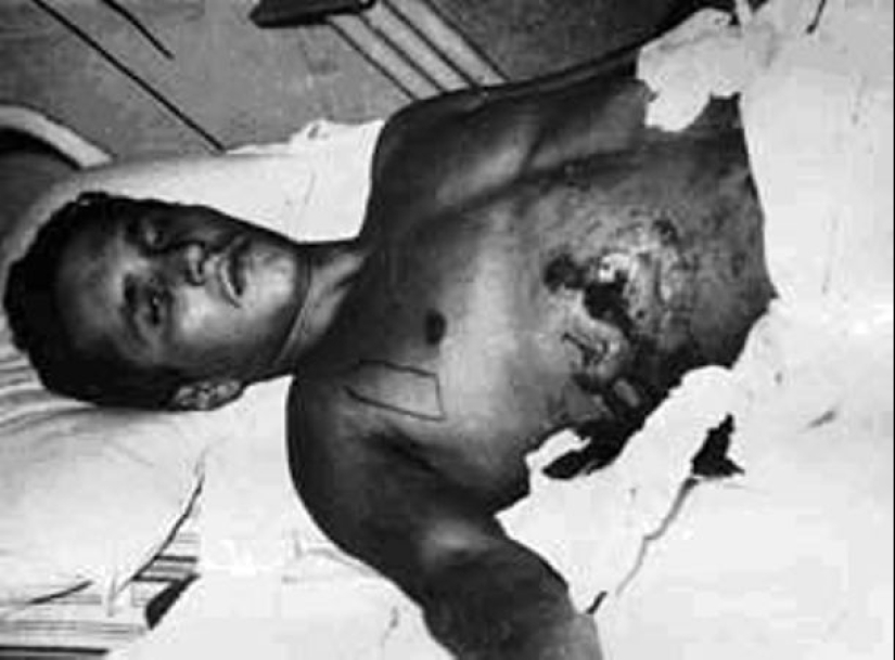 Cómo los cirujanos soviéticos liberaron a una persona viva