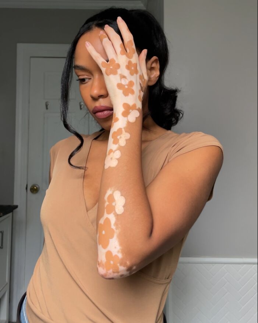 Dancer-Turned-Artist Amara Aleman Turns Her Vitiligo Into Vibrant Body Art