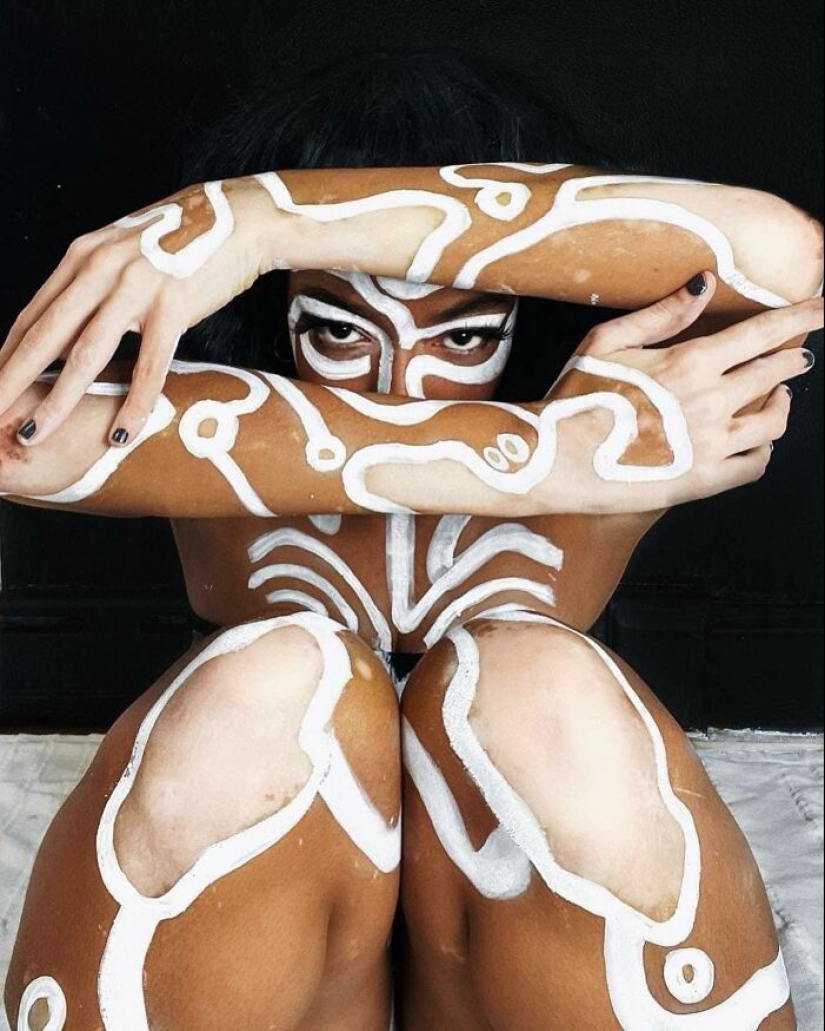 Dancer-Turned-Artist Amara Aleman Turns Her Vitiligo Into Vibrant Body Art