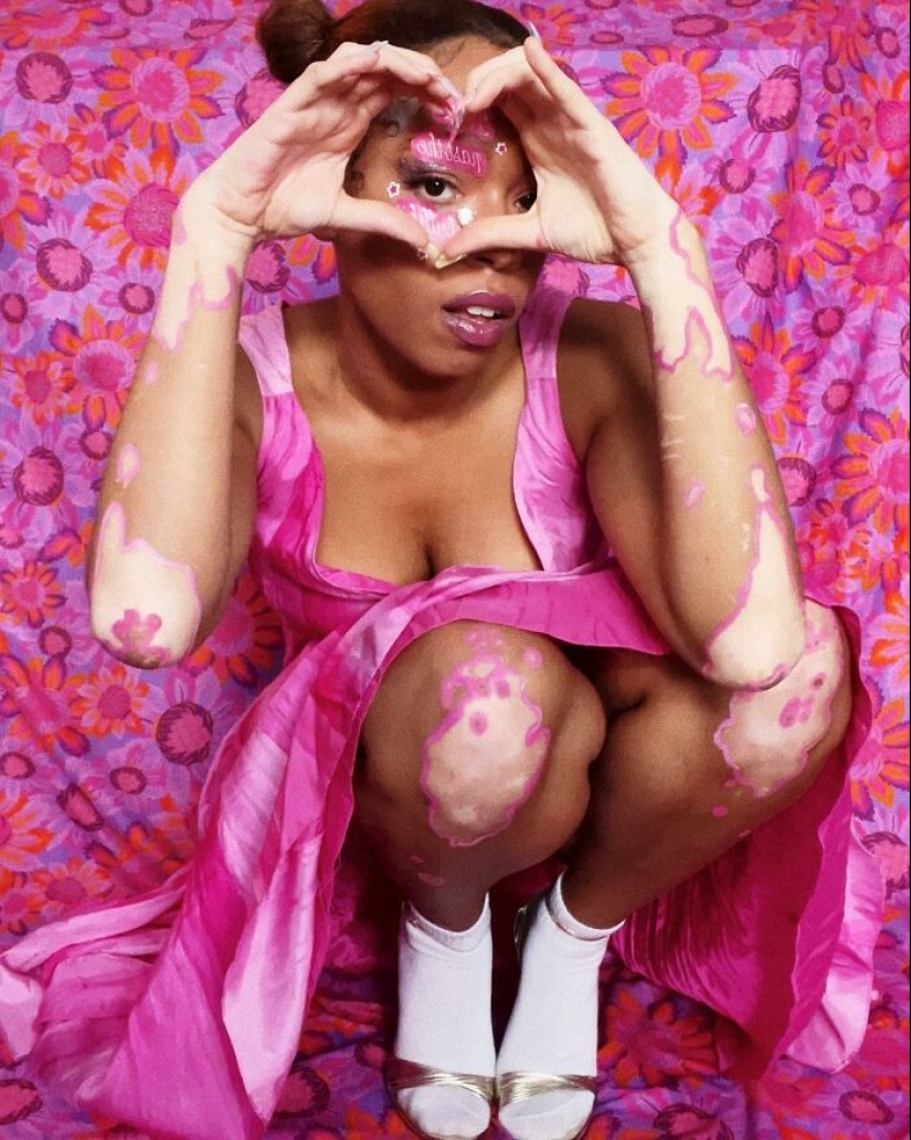 Dancer-Turned-Artist Amara Aleman Turns Her Vitiligo Into Vibrant Body Art