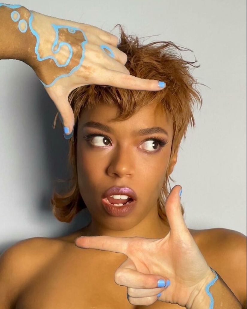 Dancer-Turned-Artist Amara Aleman Turns Her Vitiligo Into Vibrant Body Art